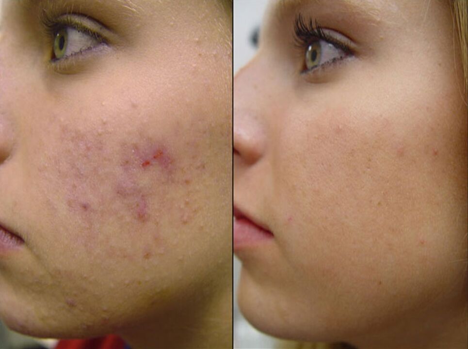πριν και μετά την αναζωογόνηση του δέρματος, φωτογραφία 2