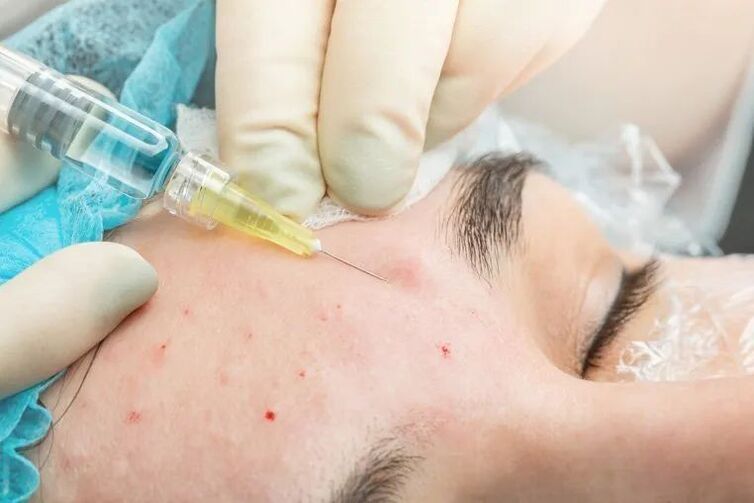 Πώς λειτουργεί το plasma lifting;