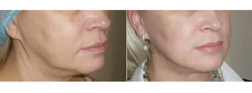 Ανάρρωση μετά την αναζωογόνηση του δέρματος