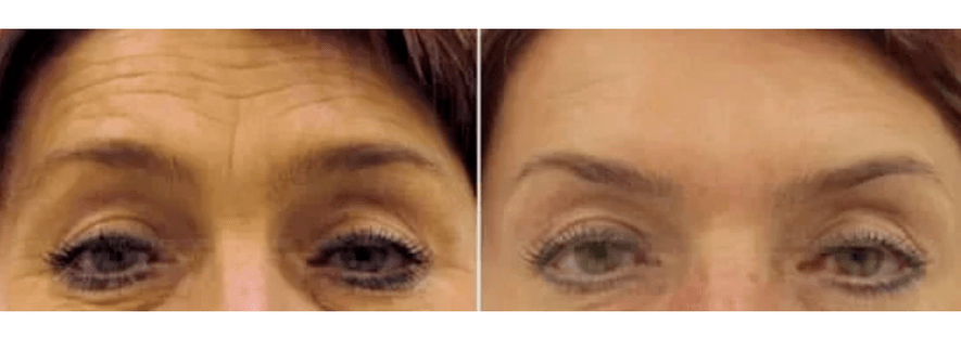 Συσκευές κλασματικής αναζωογόνησης